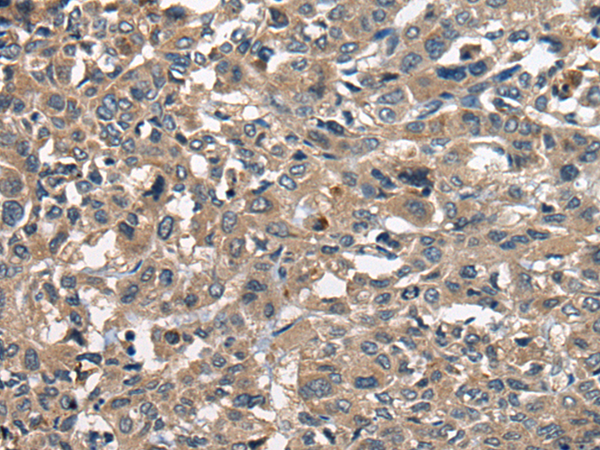 Immunohistochemistry of paraffin-embedded Human liver cancer tissue using TA368026 (RCOR2 Antibody) at dilution 1/20 (Original magnification: x200)