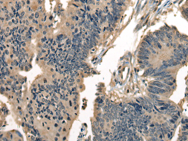 Immunohistochemistry of paraffin-embedded Human colorectal cancer tissue using TA368035 (DNAJC2 Antibody) at dilution 1/40 (Original magnification: x200)