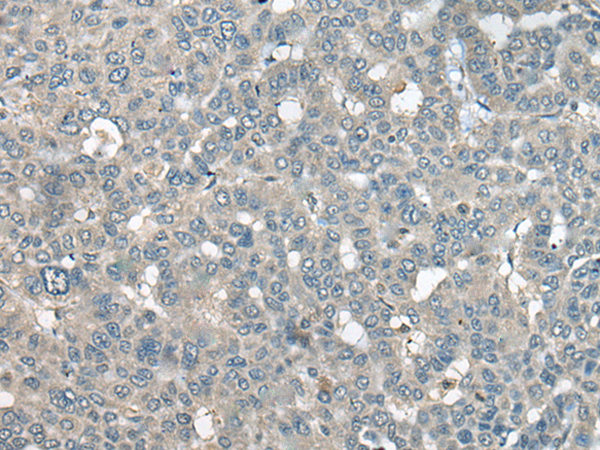 Immunohistochemistry of paraffin-embedded Human liver cancer tissue using TA368064 (UCN3 Antibody) at dilution 1/55 (Original magnification: x200)