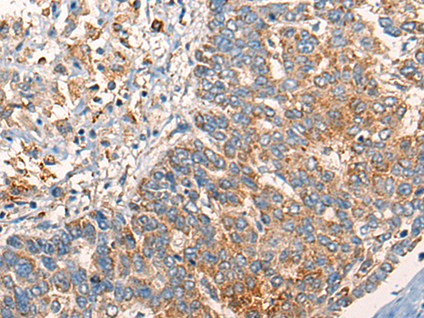 Immunohistochemistry of paraffin-embedded Human liver cancer tissue using TA368076 (ABCC6 Antibody) at dilution 1/25 (Original magnification: x200)