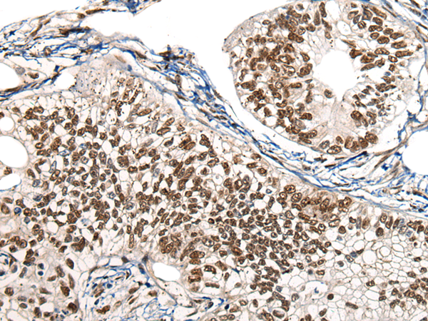 Immunohistochemistry of paraffin-embedded Human gastric cancer tissue using TA368077 (HNRNPR Antibody) at dilution 1/20 (Original magnification: x200)
