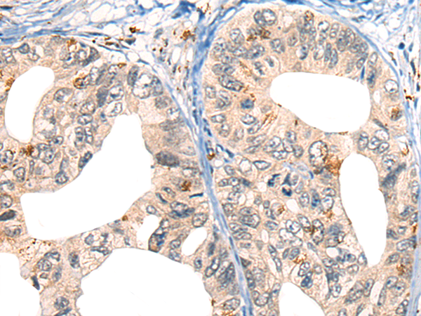Immunohistochemistry of paraffin-embedded Human gastric cancer tissue using TA368087 (CORO2B Antibody) at dilution 1/40 (Original magnification: x200)