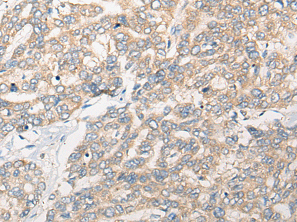 Immunohistochemistry of paraffin-embedded Human liver cancer tissue using TA368107 (REM1 Antibody) at dilution 1/25 (Original magnification: x200)