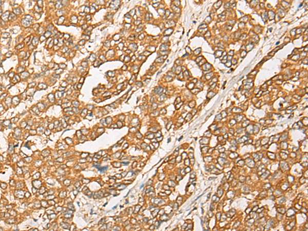 Immunohistochemistry of paraffin-embedded Human liver cancer tissue using TA368126 (GNB1L Antibody) at dilution 1/35 (Original magnification: x200)