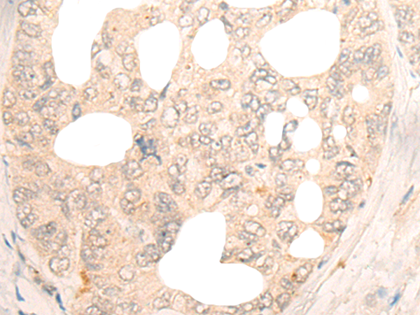 Immunohistochemistry of paraffin-embedded Human gastric cancer tissue using TA368162 (DBX2 Antibody) at dilution 1/20 (Original magnification: x200)