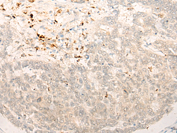 Immunohistochemistry of paraffin-embedded Human liver cancer tissue using TA368168 (ALX4 Antibody) at dilution 1/20 (Original magnification: x200)