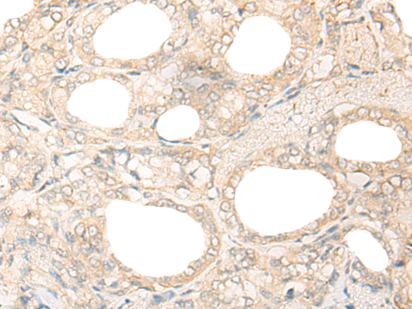 Immunohistochemistry of paraffin-embedded Human thyroid cancer tissue using TA368172 (USP11 Antibody) at dilution 1/25 (Original magnification: x200)