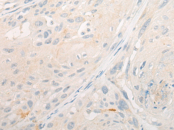 Immunohistochemistry of paraffin-embedded Human esophagus cancer tissue using TA368188 (DLEC1 Antibody) at dilution 1/25 (Original magnification: x200)