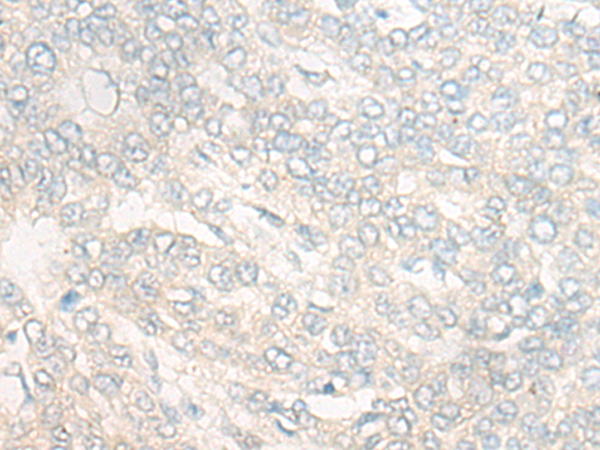 Immunohistochemistry of paraffin-embedded Human liver cancer tissue using TA368194 (POLG Antibody) at dilution 1/20 (Original magnification: x200)