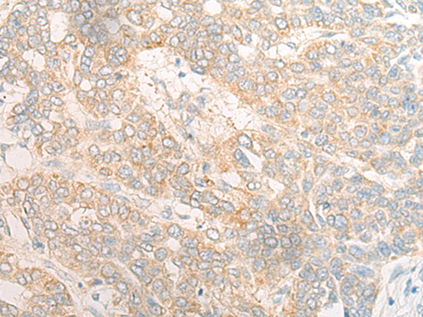 Immunohistochemistry of paraffin-embedded Human liver cancer tissue using TA368197 (DOC2B Antibody) at dilution 1/20 (Original magnification: x200)