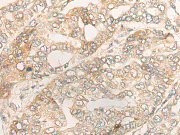 Immunohistochemistry of paraffin-embedded Human liver cancer tissue using TA368207 (DUOX2 Antibody) at dilution 1/40 (Original magnification: x200)