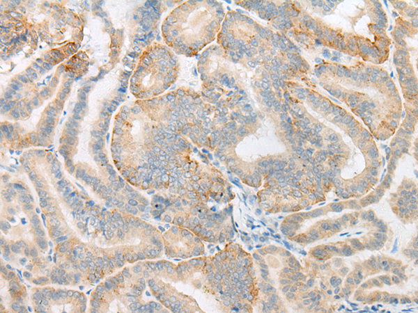 Immunohistochemistry of paraffin-embedded Human thyroid cancer tissue using TA368220 (MICU3 Antibody) at dilution 1/25 (Original magnification: x200)