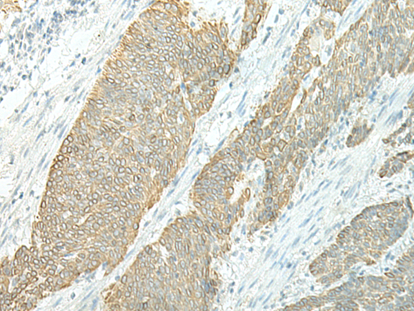 Immunohistochemistry of paraffin-embedded Human esophagus cancer tissue using TA368272 (ETAA1 Antibody) at dilution 1/25 (Original magnification: x200)