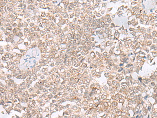 Immunohistochemistry of paraffin-embedded Human ovarian cancer tissue using TA368279 (EHMT2 Antibody) at dilution 1/20 (Original magnification: x200)