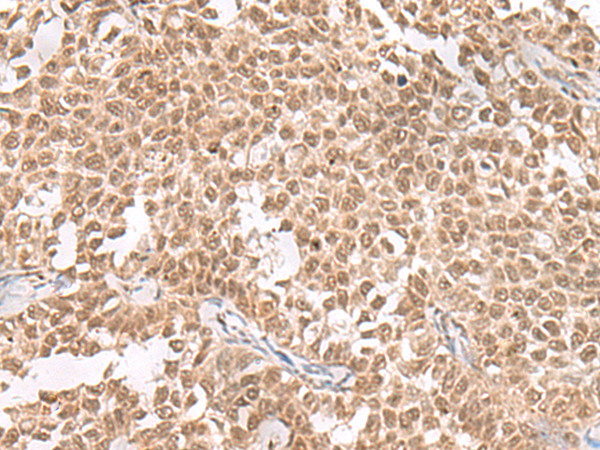 Immunohistochemistry of paraffin-embedded Human ovarian cancer tissue using TA368280 (ZNF560 Antibody) at dilution 1/25 (Original magnification: x200)
