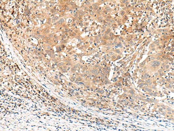 Immunohistochemistry of paraffin-embedded Human cervical cancer tissue using TA368289 (KCNA10 Antibody) at dilution 1/40 (Original magnification: x200)
