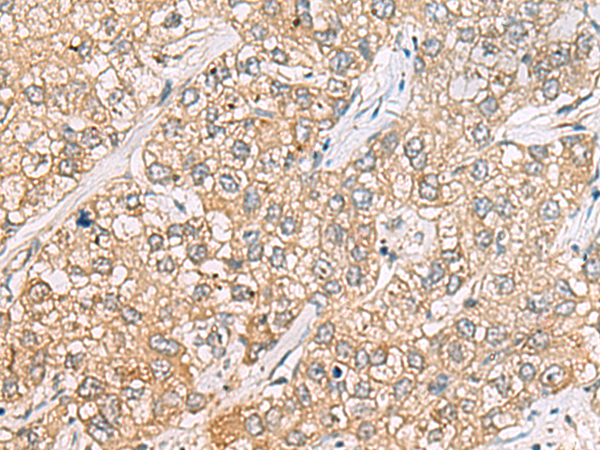 Immunohistochemistry of paraffin-embedded Human liver cancer tissue using TA368290 (P3H2 Antibody) at dilution 1/30 (Original magnification: x200)