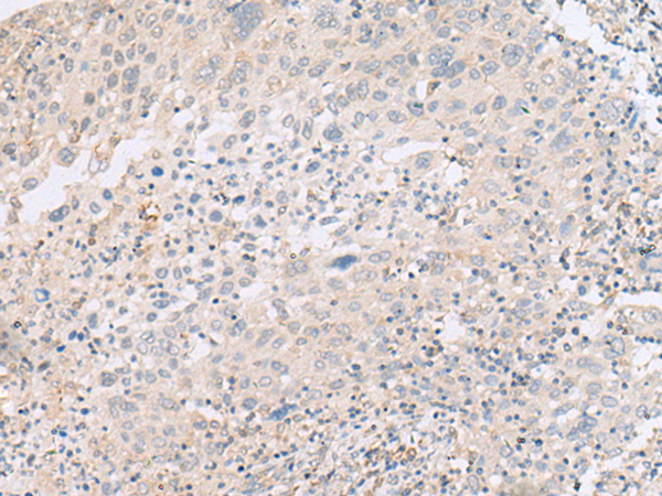 Immunohistochemistry of paraffin-embedded Human cervical cancer tissue using TA368296 (ABHD17B Antibody) at dilution 1/20 (Original magnification: x200)