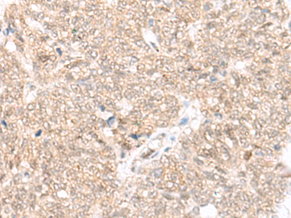 Immunohistochemistry of paraffin-embedded Human ovarian cancer tissue using TA368297 (FAM111B Antibody) at dilution 1/25 (Original magnification: x200)
