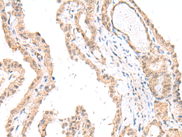 Immunohistochemistry of paraffin-embedded Human thyroid cancer tissue using TA368309 (FANCE Antibody) at dilution 1/50 (Original magnification: x200)