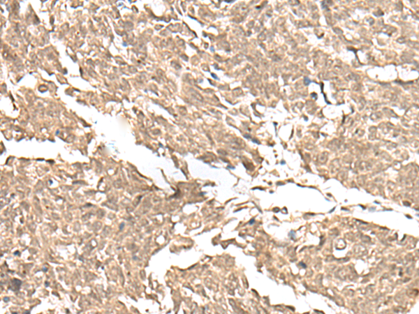 Immunohistochemistry of paraffin-embedded Human lung cancer tissue using TA368311 (KDM2A Antibody) at dilution 1/55 (Original magnification: x200)