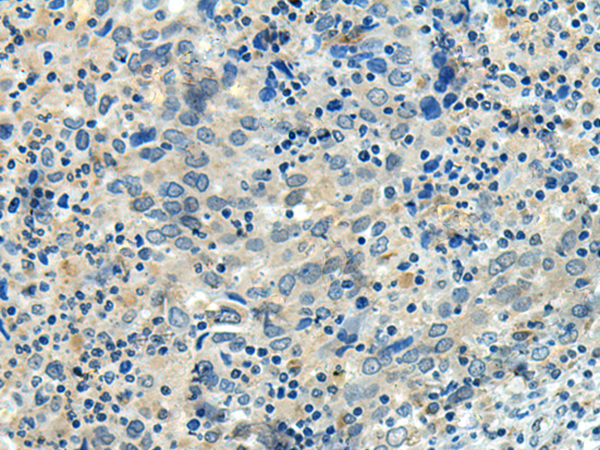 Immunohistochemistry of paraffin-embedded Human cervical cancer tissue using TA368312 (FBXL16 Antibody) at dilution 1/40 (Original magnification: x200)