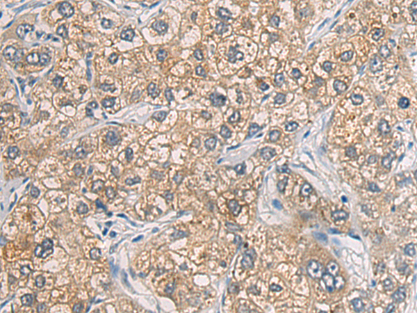 Immunohistochemistry of paraffin-embedded Human liver cancer tissue using TA368347 (GAB4 Antibody) at dilution 1/60 (Original magnification: x200)