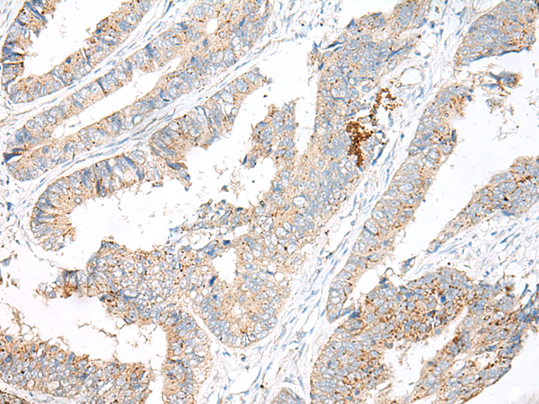 Immunohistochemistry of paraffin-embedded Human colorectal cancer tissue using TA368357 (GARNL3 Antibody) at dilution 1/60 (Original magnification: x200)