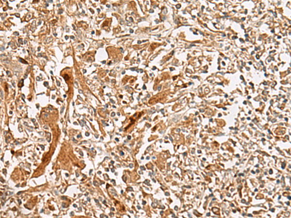 Immunohistochemistry of paraffin-embedded Human liver cancer tissue using TA368363 (GCC2 Antibody) at dilution 1/45 (Original magnification: x200)