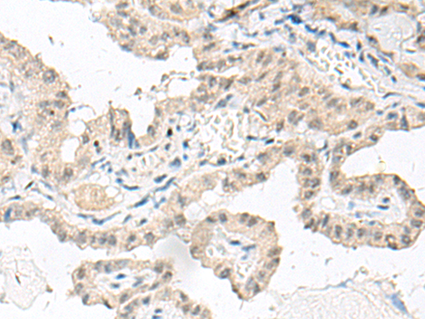 Immunohistochemistry of paraffin-embedded Human thyroid cancer tissue using TA368369 (GFI1B Antibody) at dilution 1/80 (Original magnification: x200)