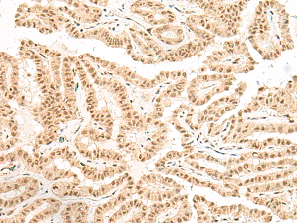 Immunohistochemistry of paraffin-embedded Human thyroid cancer tissue using TA368375 (BICRA Antibody) at dilution 1/40 (Original magnification: x200)