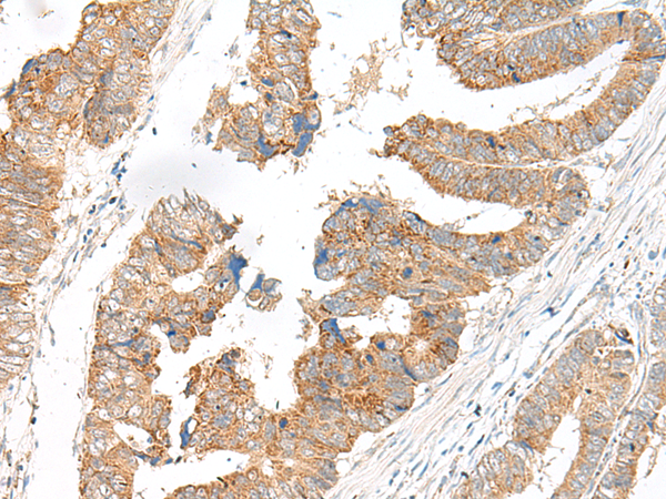 Immunohistochemistry of paraffin-embedded Human colorectal cancer tissue using TA368381 (SLC6A9 Antibody) at dilution 1/25 (Original magnification: x200)