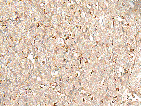 Immunohistochemistry of paraffin-embedded Human ovarian cancer tissue using TA368388 (NUP210 Antibody) at dilution 1/30 (Original magnification: x200)