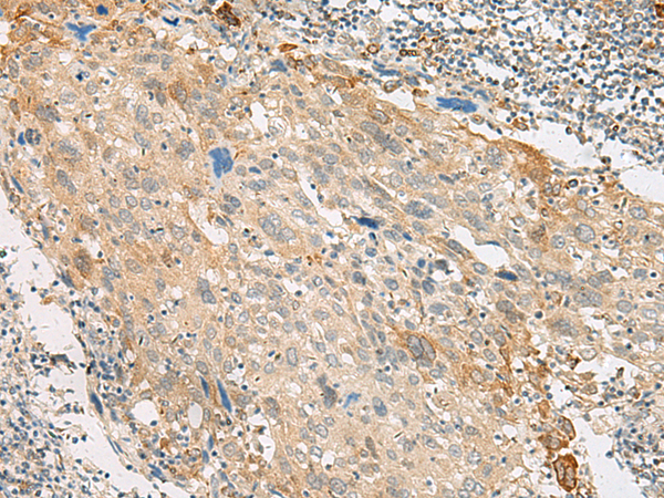 Immunohistochemistry of paraffin-embedded Human cervical cancer tissue using TA368389 (GPR151 Antibody) at dilution 1/45 (Original magnification: x200)