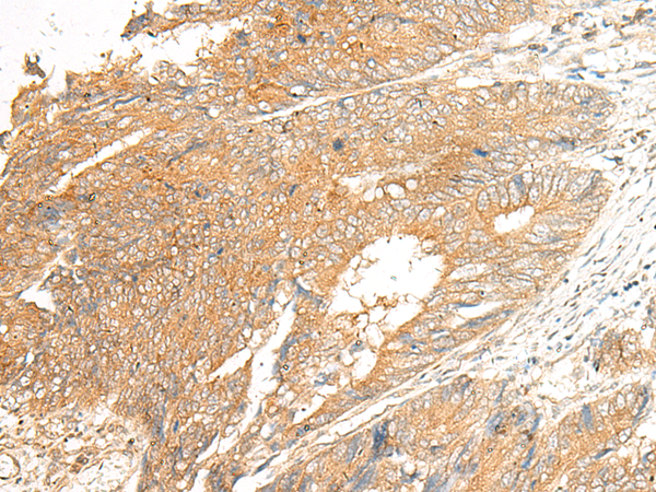 Immunohistochemistry of paraffin-embedded Human colorectal cancer tissue using TA368390 (C5AR2 Antibody) at dilution 1/25 (Original magnification: x200)