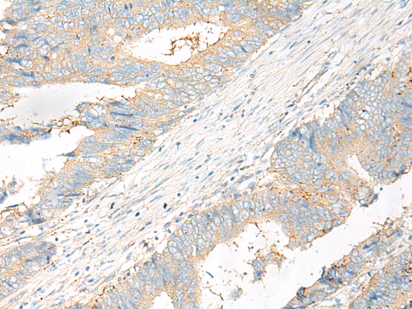 Immunohistochemistry of paraffin-embedded Human colorectal cancer tissue using TA368399 (FFAR4 Antibody) at dilution 1/20 (Original magnification: x200)
