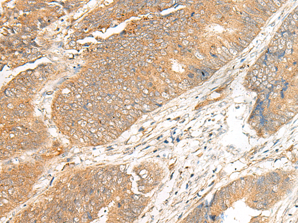 Immunohistochemistry of paraffin-embedded Human colorectal cancer tissue using TA368413 (ARHGEF18 Antibody) at dilution 1/20 (Original magnification: x200)