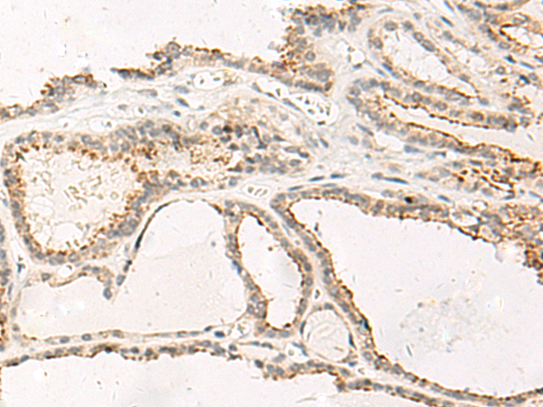 Immunohistochemistry of paraffin-embedded Human thyroid cancer tissue using TA368430 (MCHR2 Antibody) at dilution 1/20 (Original magnification: x200)
