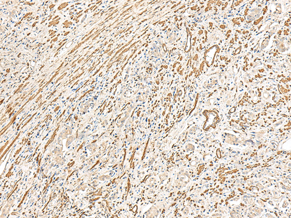 Immunohistochemistry of paraffin-embedded Human prostate cancer tissue using TA368433 (MRGPRD Antibody) at dilution 1/25 (Original magnification: x200)