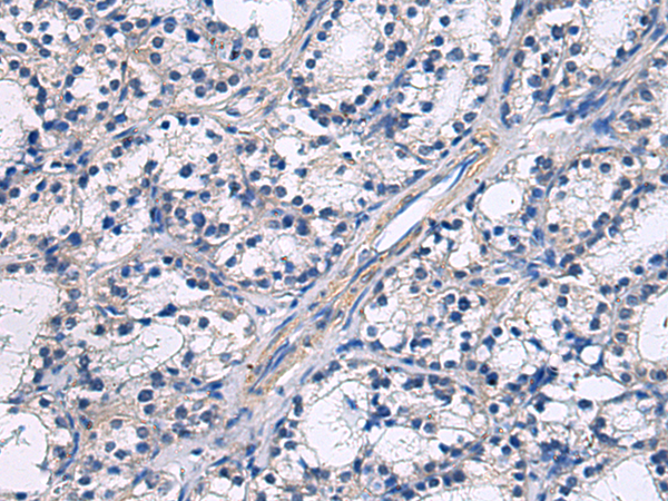 Immunohistochemistry of paraffin-embedded Human thyroid cancer using TA368453 (GRAMD2A Antibody) at dilution 1/45 (Original magnification: x200)