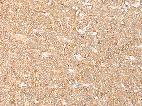 Immunohistochemistry of paraffin-embedded Human ovarian cancer tissue using TA368461 (LGALSL Antibody) at dilution 1/70 (Original magnification: x200)