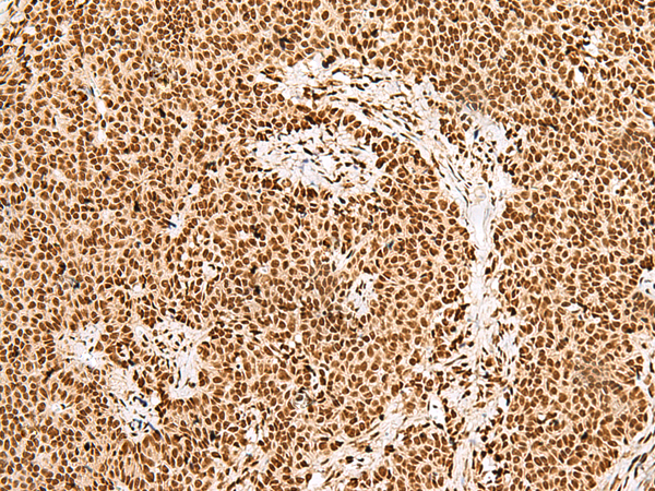 Immunohistochemistry of paraffin-embedded Human ovarian cancer tissue using TA368463 (GRSF1 Antibody) at dilution 1/30 (Original magnification: x200)