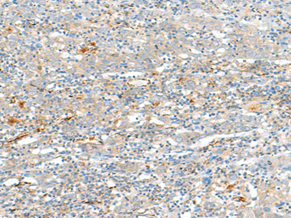 Immunohistochemistry of paraffin-embedded Human cervical cancer tissue using TA368503 (HLA-DQA2 Antibody) at dilution 1/20 (Original magnification: x200)