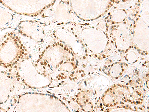 Immunohistochemistry of paraffin-embedded Human thyroid cancer tissue using TA368509 (HNRNPA3 Antibody) at dilution 1/30 (Original magnification: x200)
