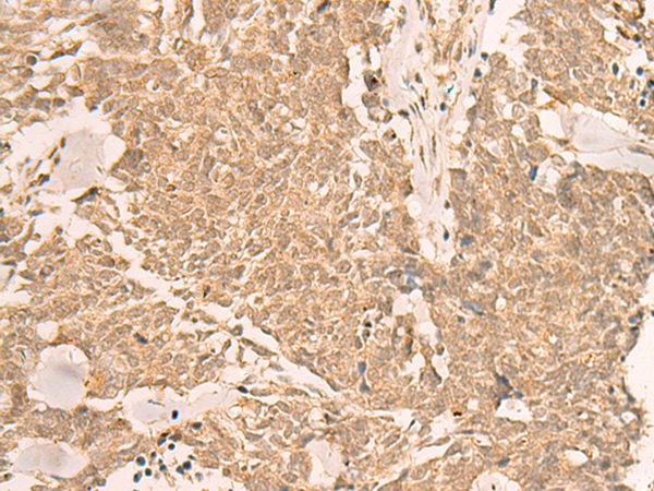 Immunohistochemistry of paraffin-embedded Human lung cancer tissue using TA368538 (IL1RAPL2 Antibody) at dilution 1/25 (Original magnification: x200)