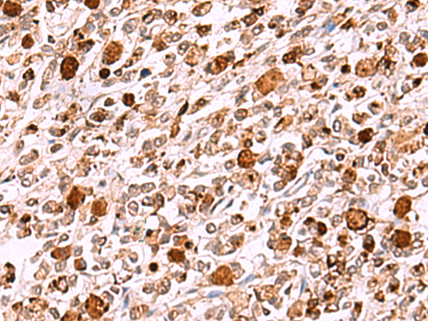 HEK293T cells were transfected with the pCMV6-ENTRY control (Left lane) or pCMV6-ENTRY PACSIN3 (RC204103, Right lane) cDNA for 48 hrs and lysed. Equivalent amounts of cell lysates (5 ug per lane) were separated by SDS-PAGE and immunoblotted with anti-PACSIN3. Positive lysates LY414084 (100 ug) and LC414084 (20 ug) can be purchased separately from OriGene.