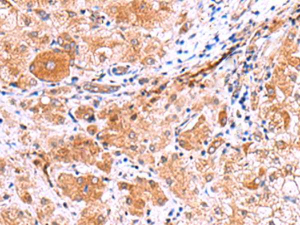 Immunohistochemistry of paraffin-embedded Human liver cancer tissue using TA368564 (IRGC Antibody) at dilution 1/30 (Original magnification: x200)