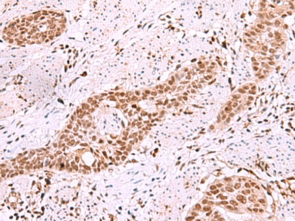 Immunohistochemistry of paraffin-embedded Human esophagus cancer tissue using TA368571 (ISL2 Antibody) at dilution 1/40 (Original magnification: x200)