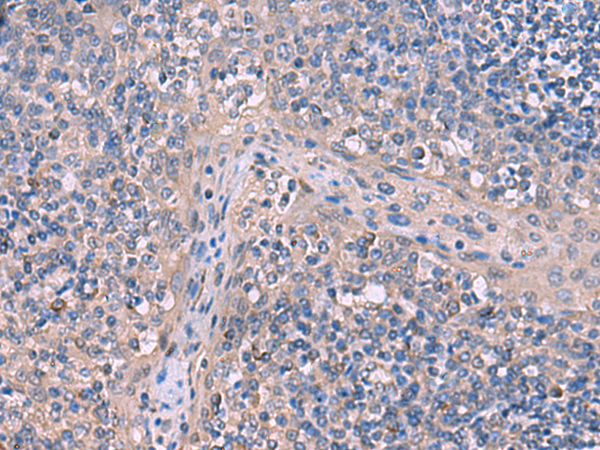 Immunohistochemistry of paraffin-embedded Human tonsil tissue using TA368578 (ITPR2 Antibody) at dilution 1/65 (Original magnification: x200)
