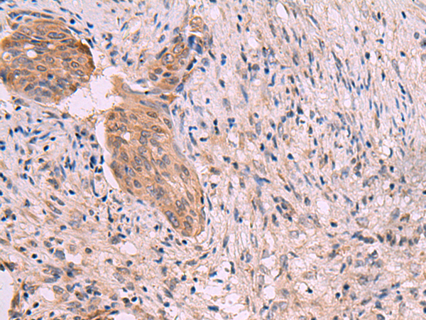 Immunohistochemistry of paraffin-embedded Human cervical cancer tissue using TA368590 (GRIK4 Antibody) at dilution 1/30 (Original magnification: x200)